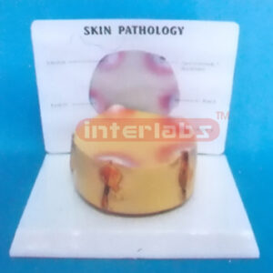 DESK-TYPE COMMON PATHOLOGIES MODEL OF ACNE SERIES WITH DESCR