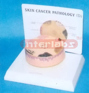 HUMAN SKIN CANCER MODEL WITH DESCRIPTION PLATE Exporter & Ed