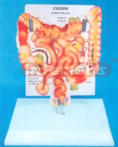 DESK TYPE HUMAN COMMON PATHOLOGIES OF THE INTESTINES SYSTEM