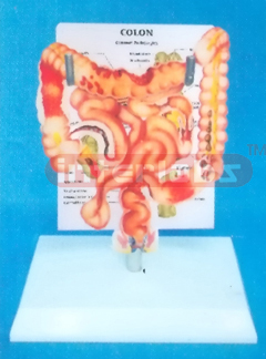 DESK TYPE HUMAN COMMON PATHOLOGIES OF THE INTESTINES SYSTEM